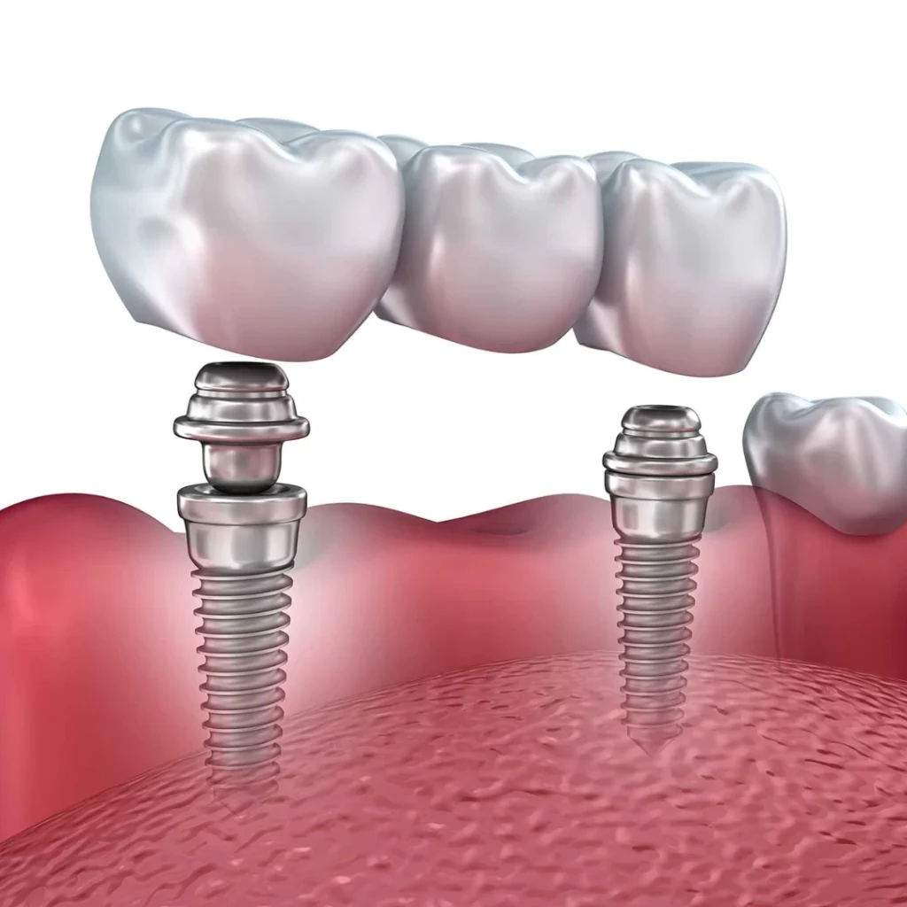 Dental Implants in Clarksville, AR