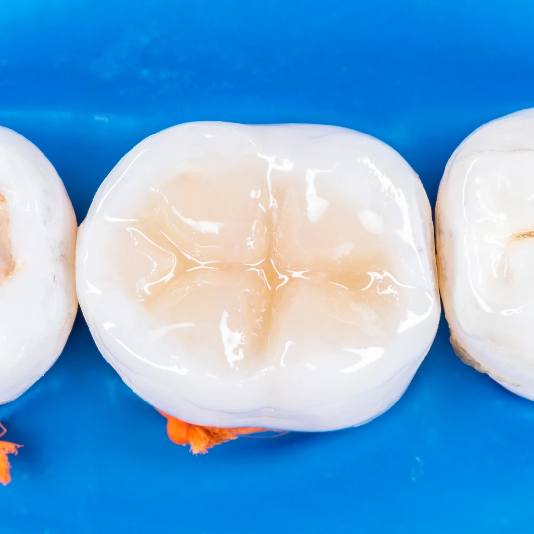 Tooth-Colored Fillings