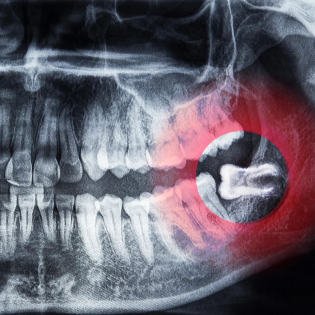 Wisdom Teeth Removal