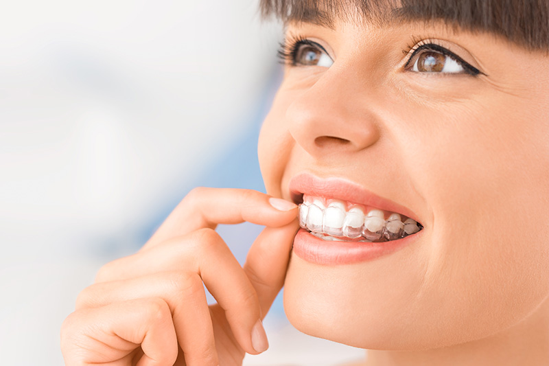 invisalign-1-2.jpg
