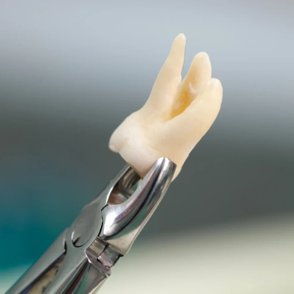 Benefits of Tooth Removal
