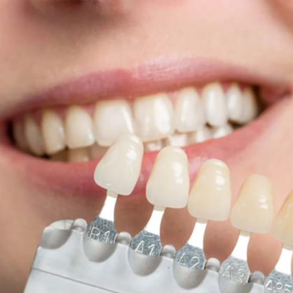 Benefits of Veneers