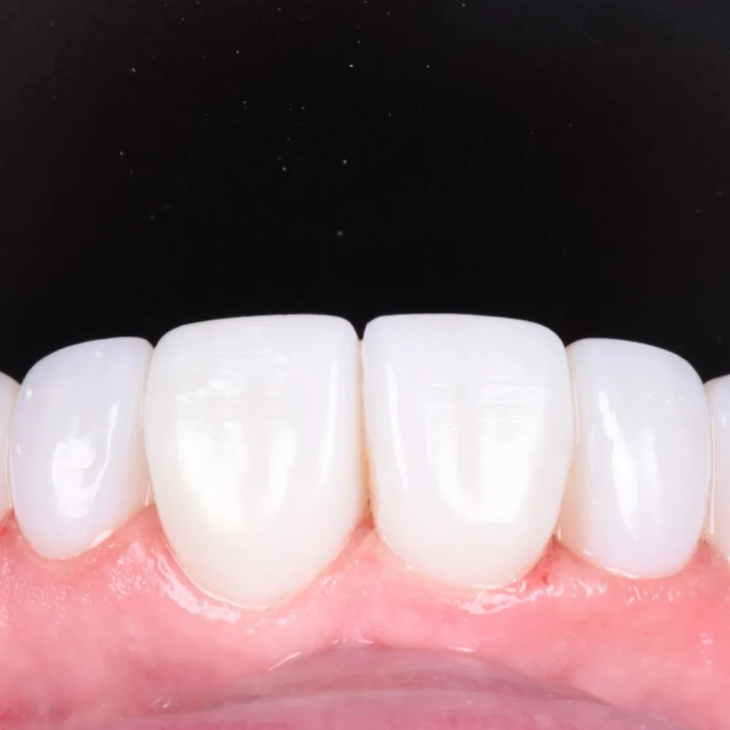 Dental Bonding Cost in Clarksville