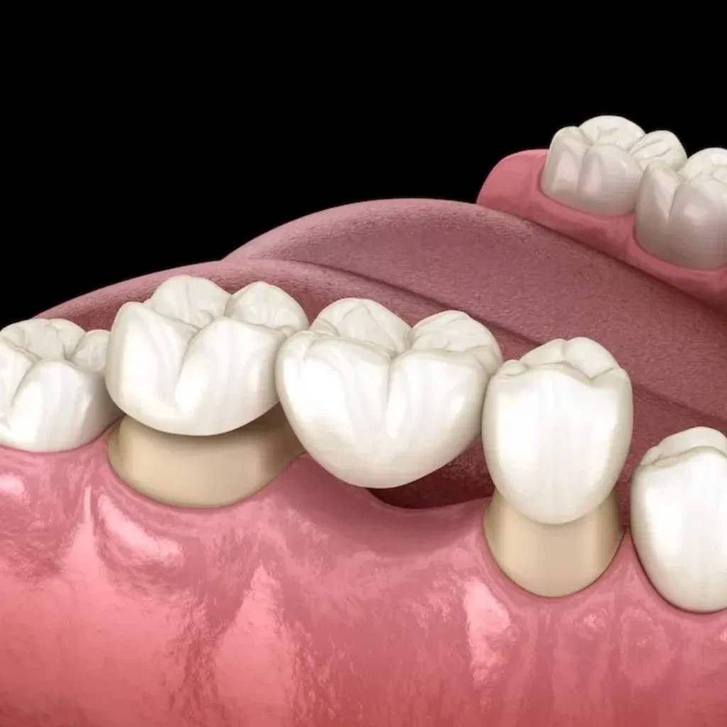 Dental Bridges in Clarksville, AR