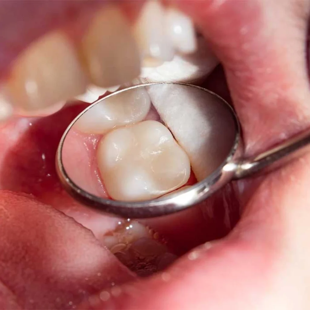 Dental Sealants in Clarksville, AR
