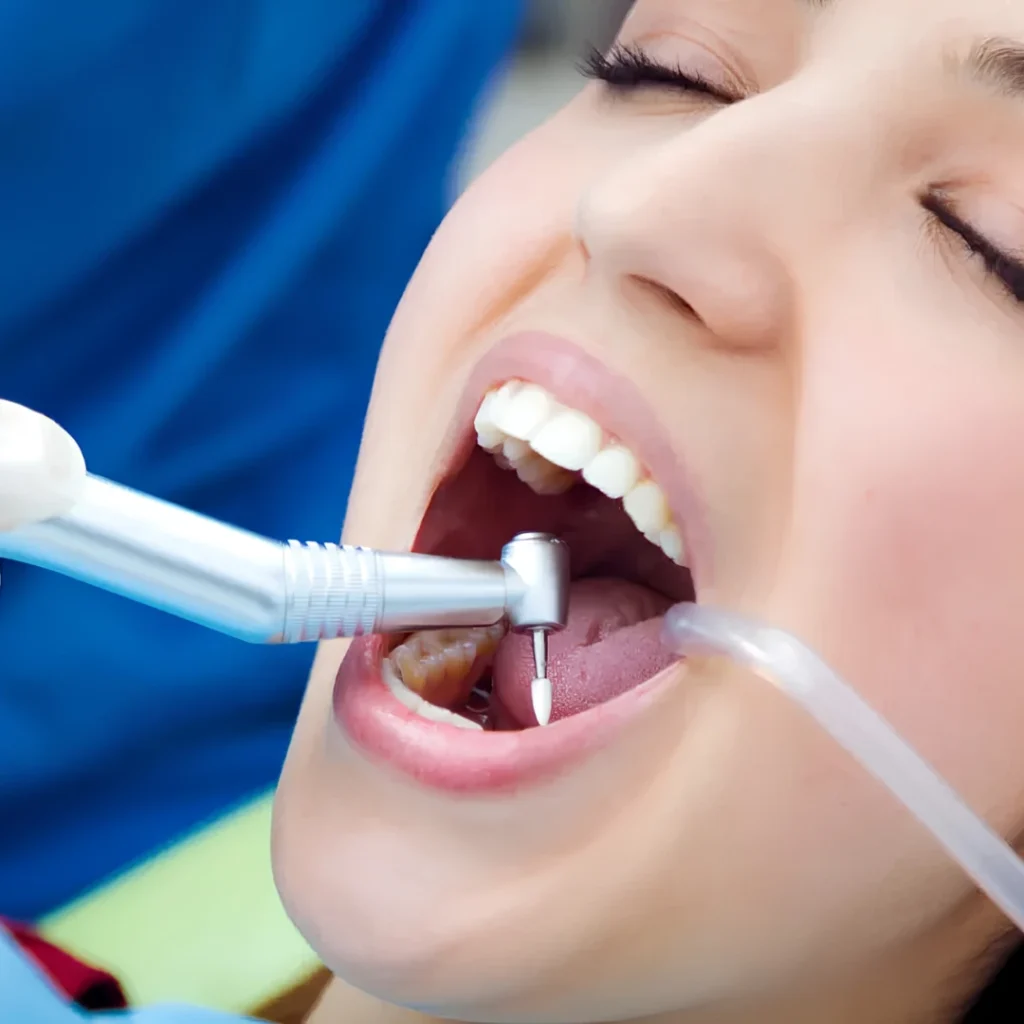 Dental White Filling Cost in Clarksville