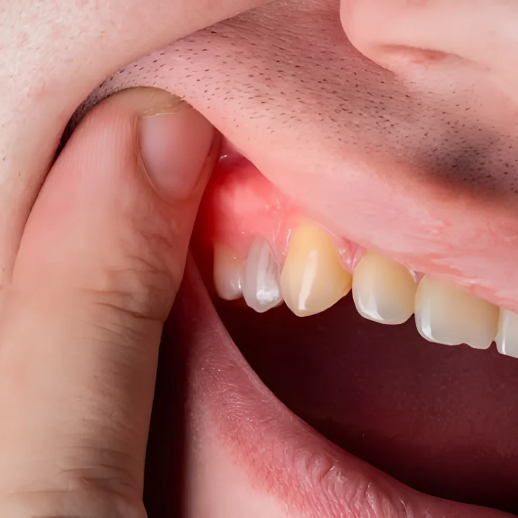 Gum Disease Treatment
