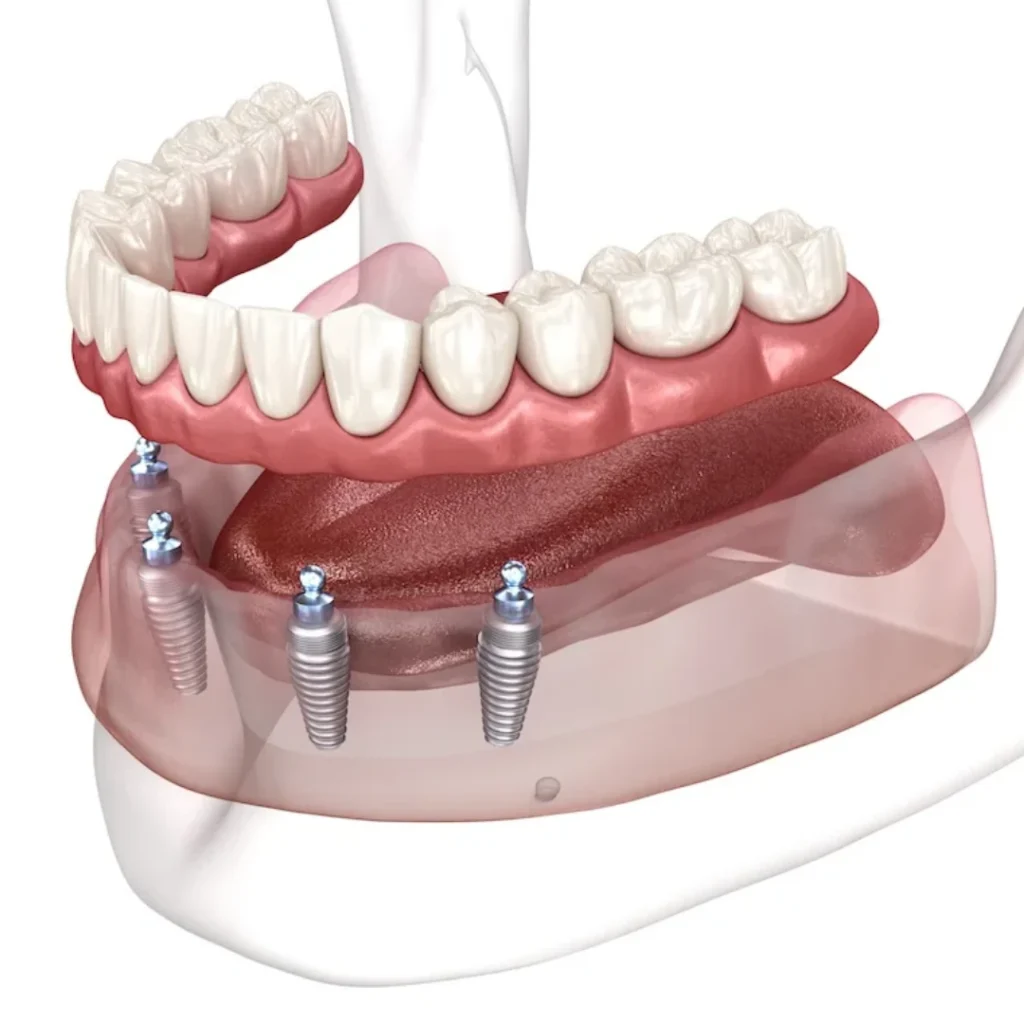 Implant-Supported Restorations