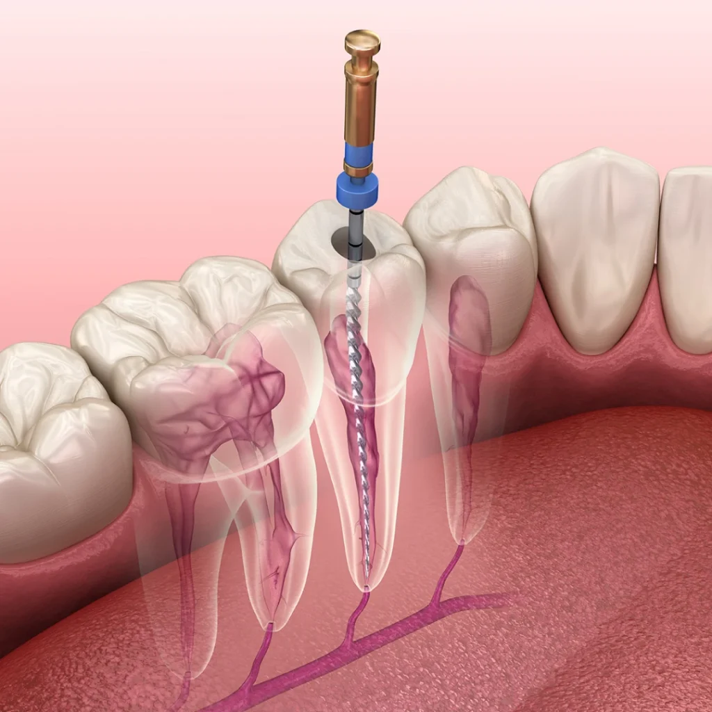 Root Canal Treatment in Clarksville, AR