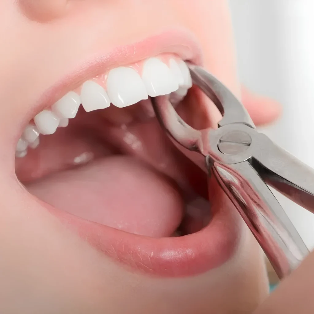Tooth Extraction Cost in Clarksville