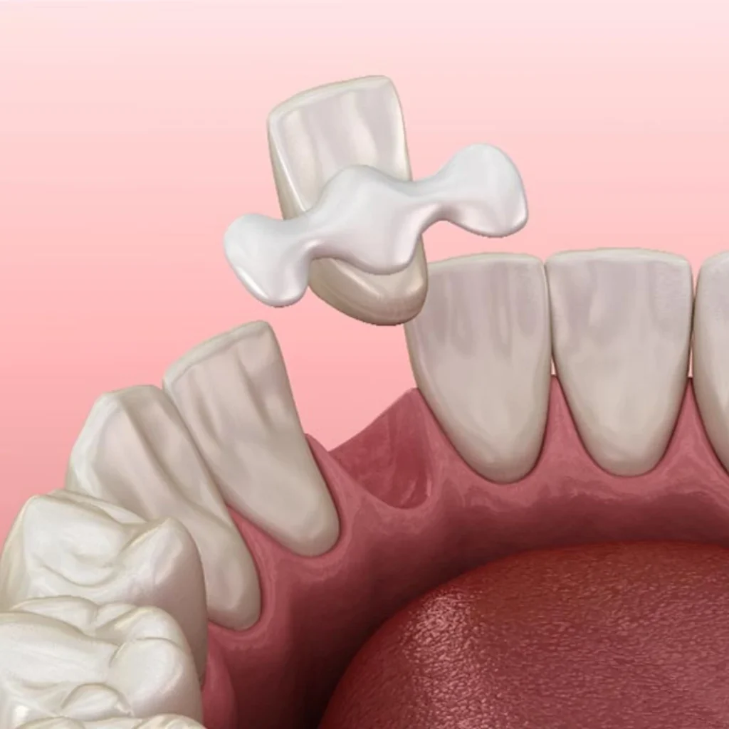 Types of Bridge Restorations