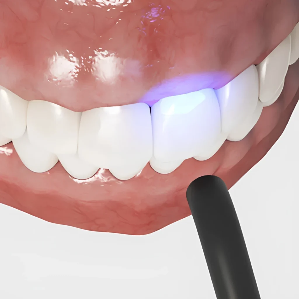What Can Dental Bonding Treat