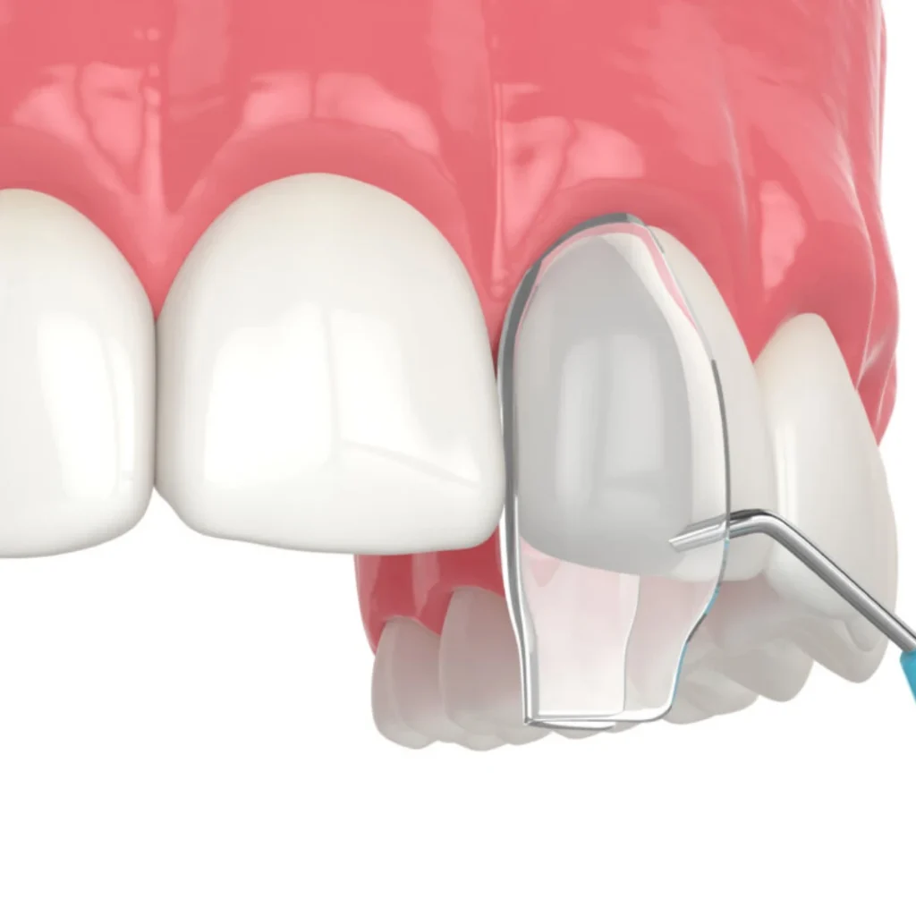 What Is Dental Bonding
