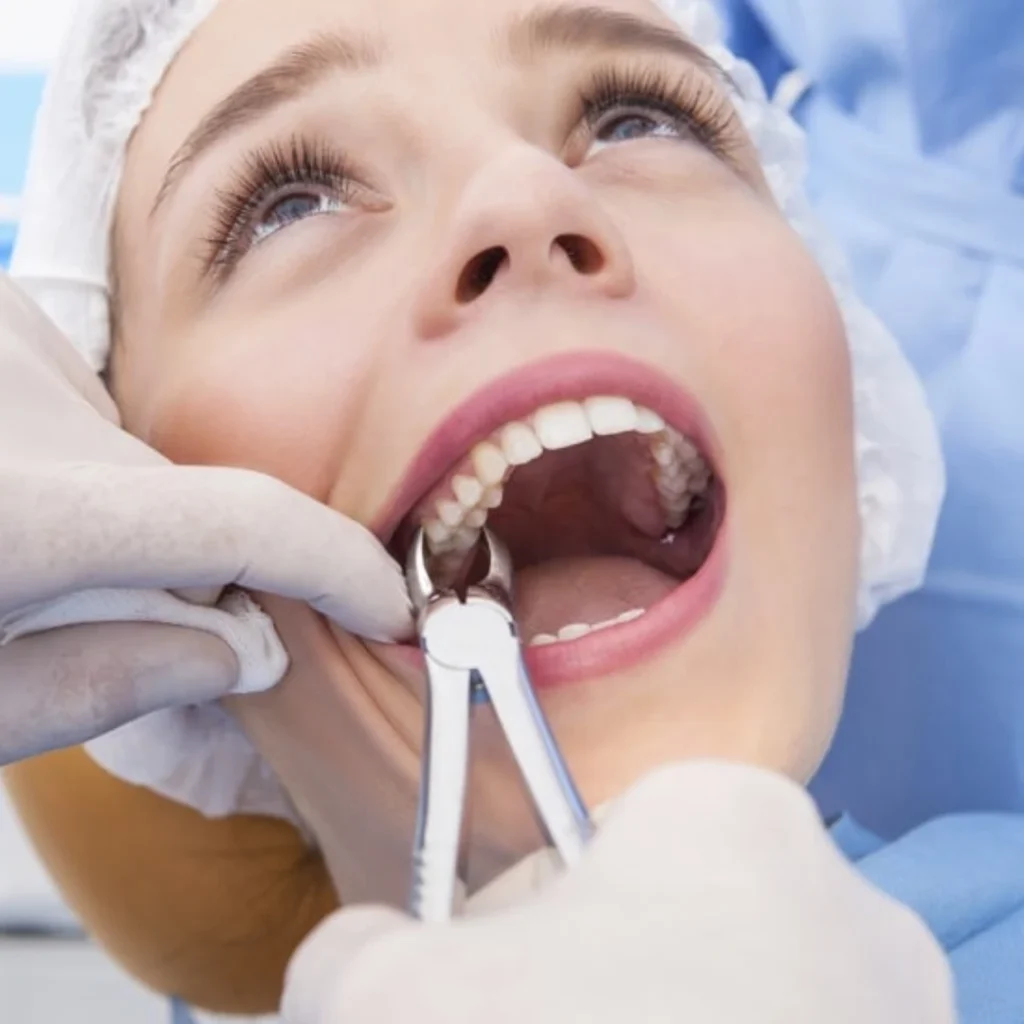 What Is Tooth Extraction
