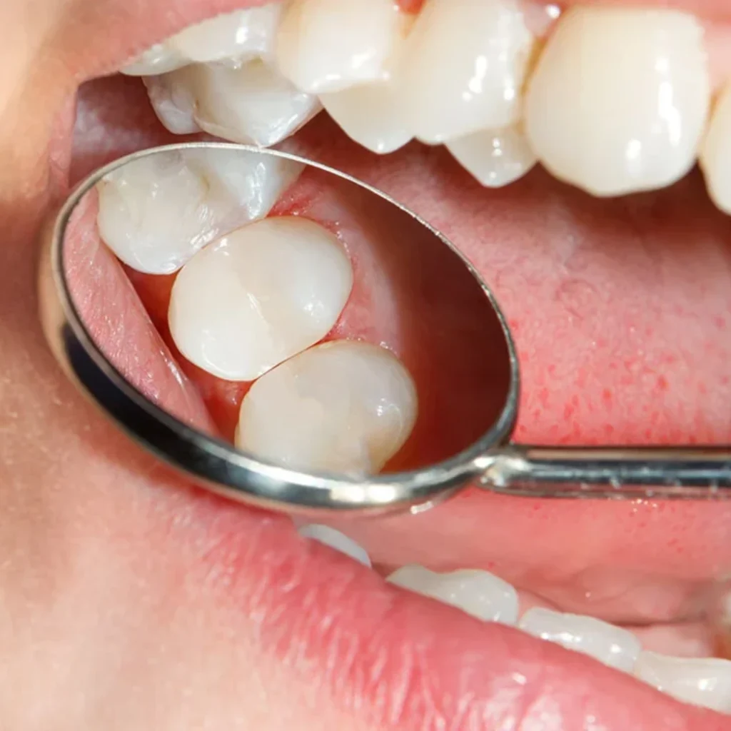 White Dental Fillings in Clarksville, AR