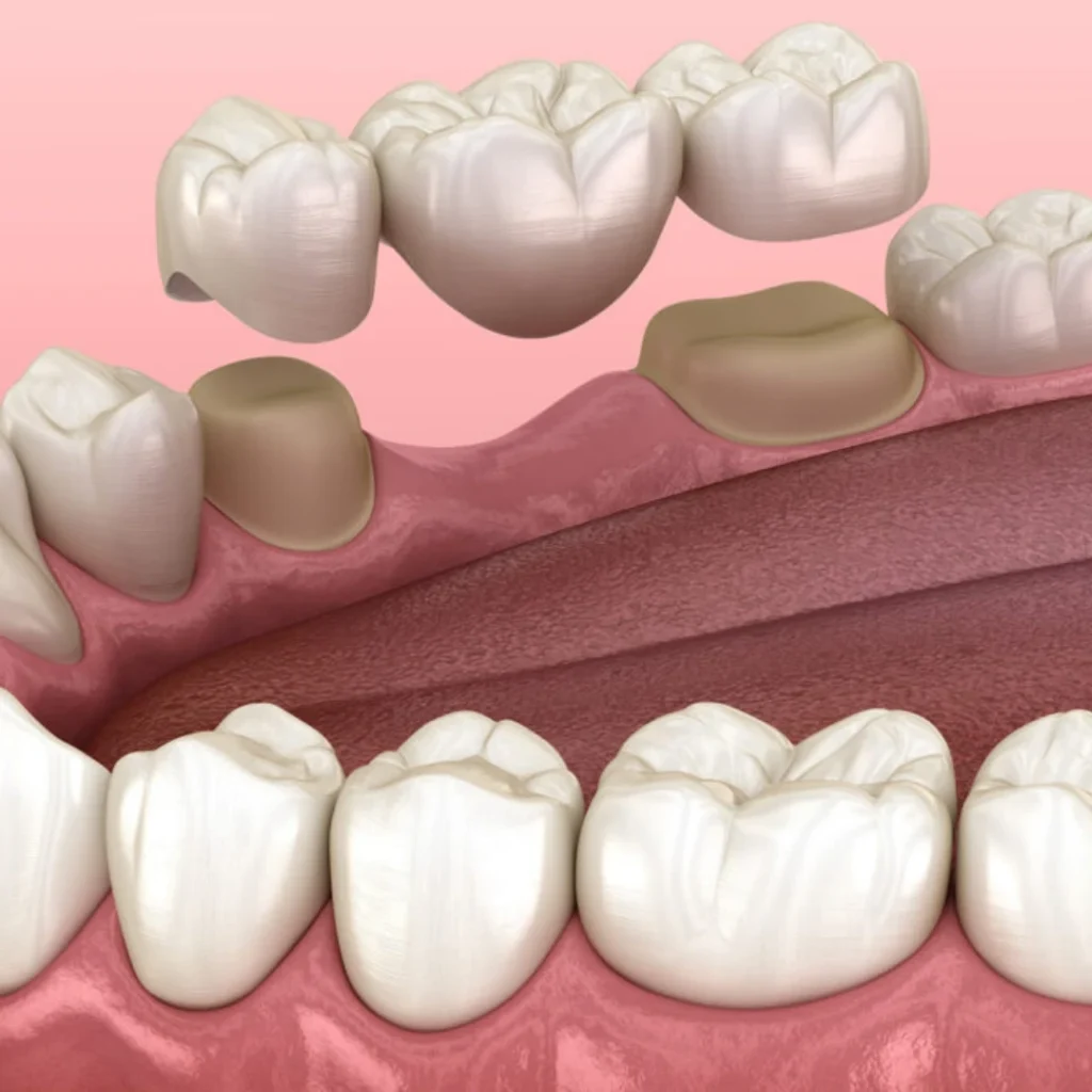 Why Consider a Dental Bridge