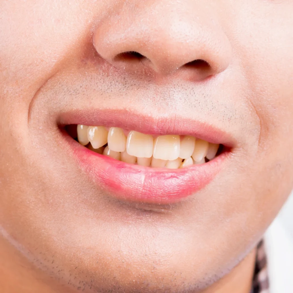 Why Do Teeth Become Discolored