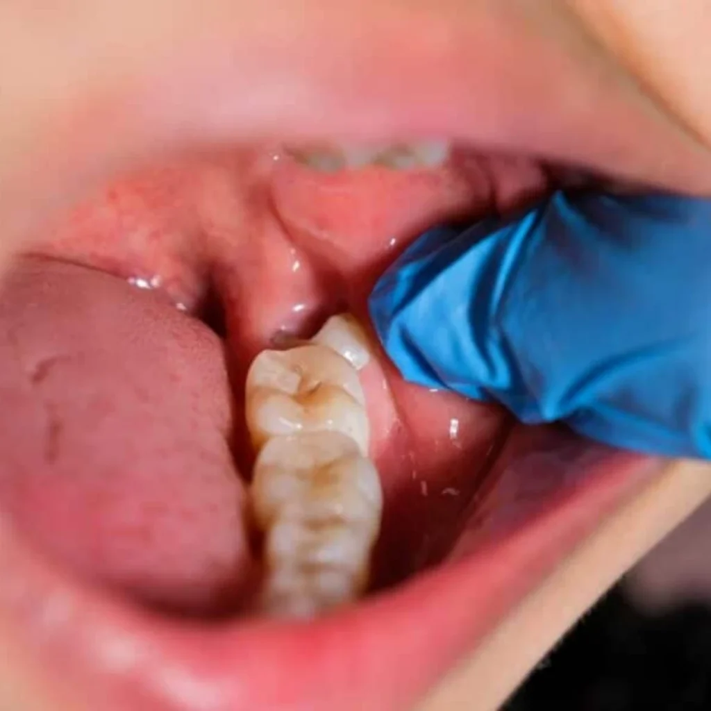 Why Is Wisdom Tooth Removal Recommended